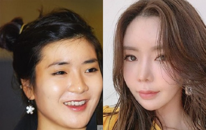 アンシネ整形外科前後