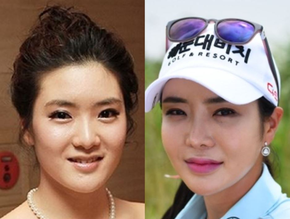 アンシネ整形外科前後