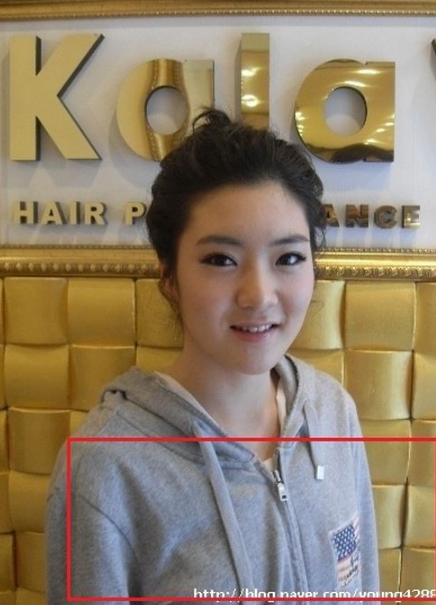 アンシネ　バスト整形