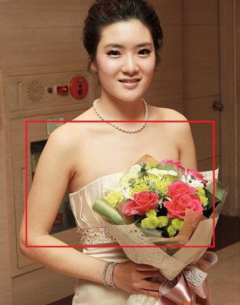 アンシネ　バスト整形